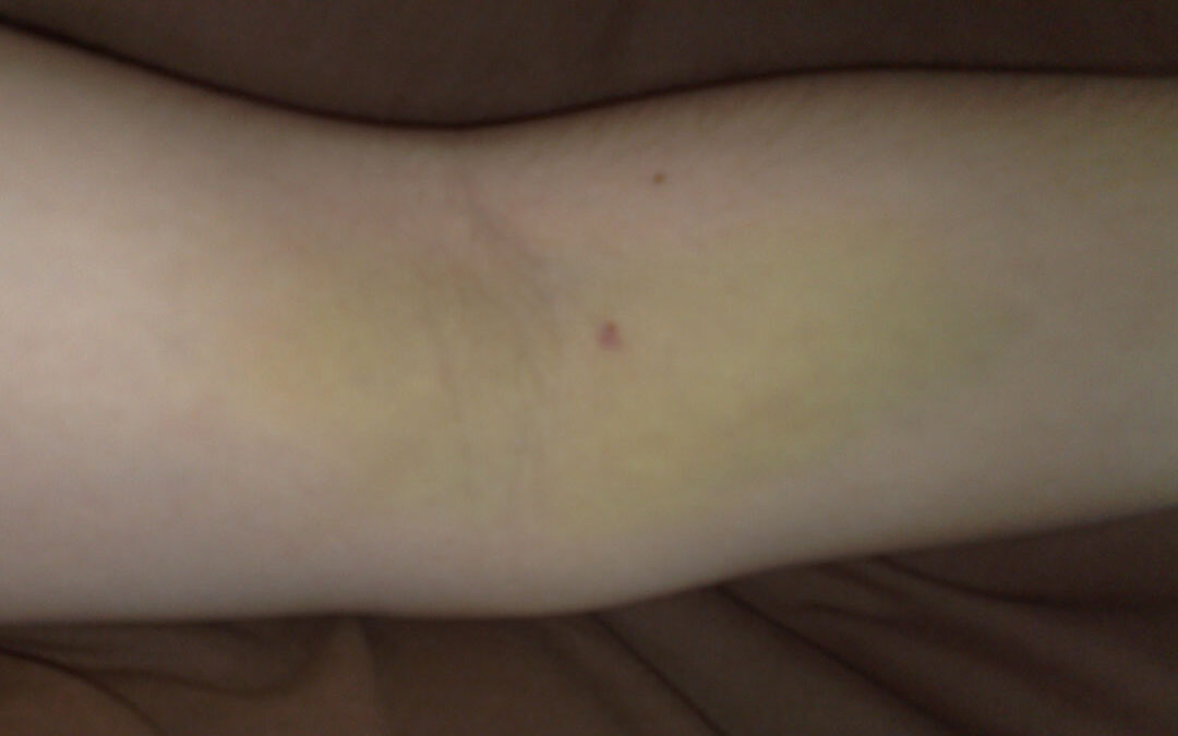 Why Do My Bruises Itch?